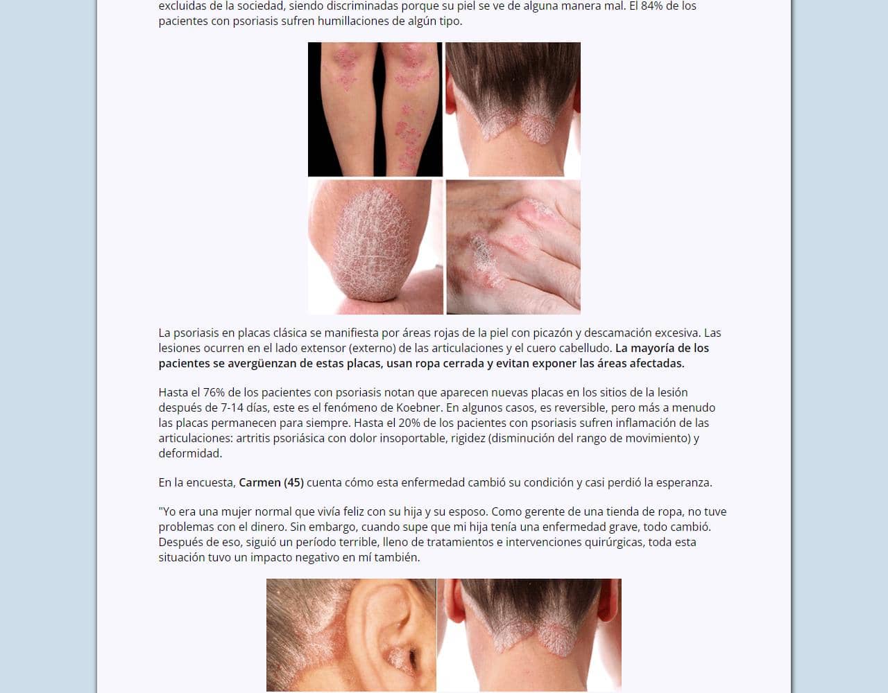 Psoriaderm 2